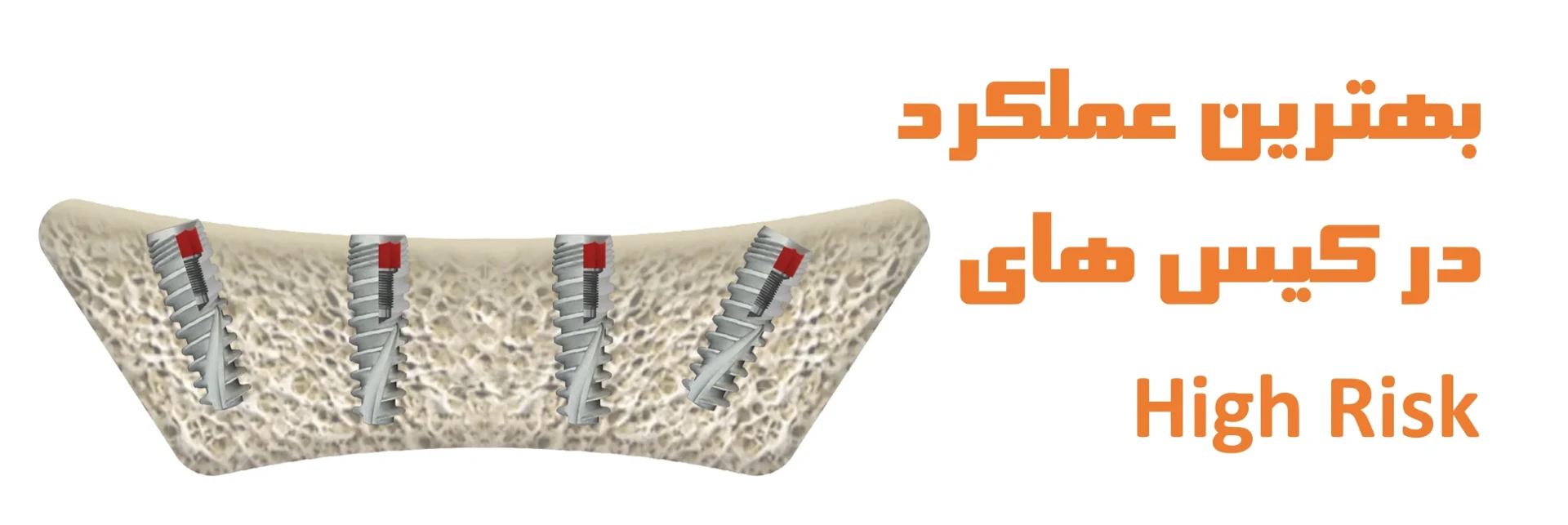 عکس بهترین عملکرد در کیس های High Risk