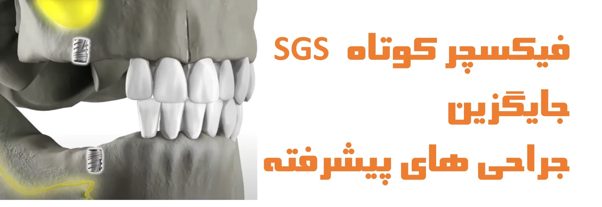 عکس فیکسچر کوتاه SGS، جایگزین جراحی های پیشرفته