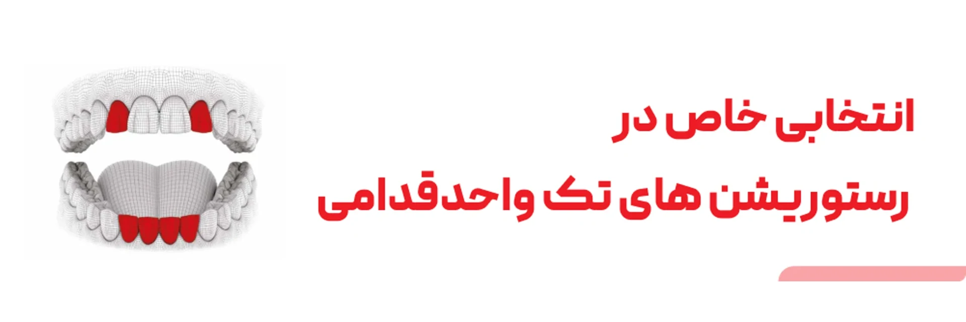 عکس فیکسچر با قطر 2.9  در رستوریشن های تک واحد قدامی