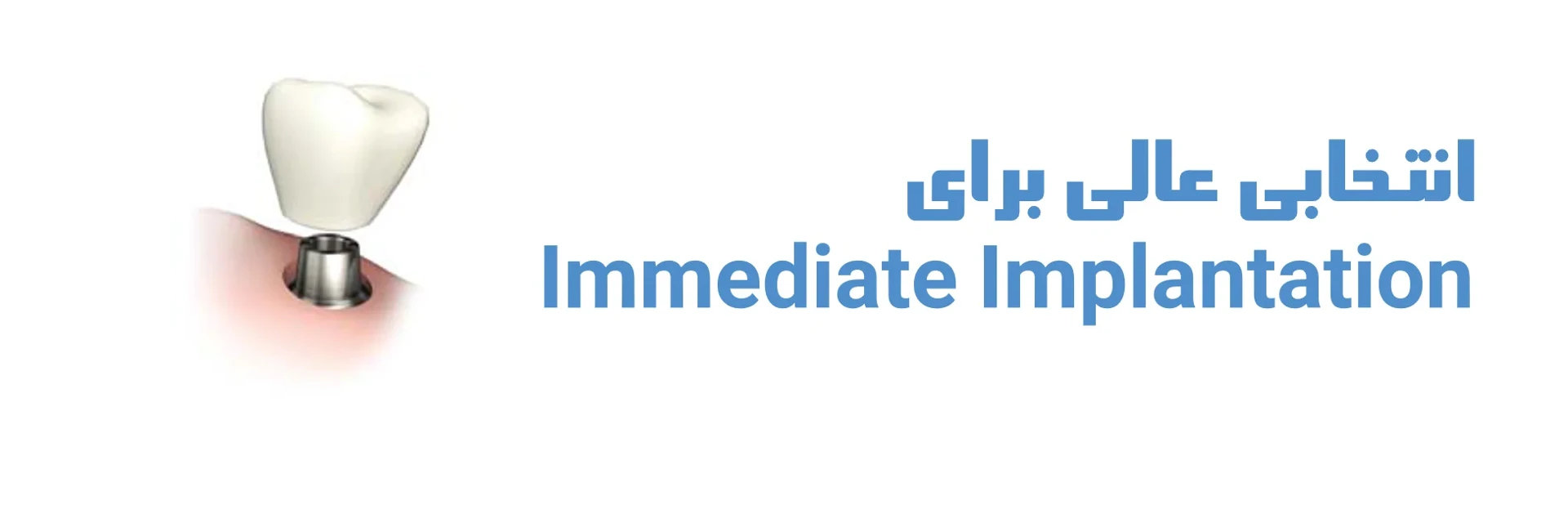 عکس انتخابی عالی برای Immediate Implantation